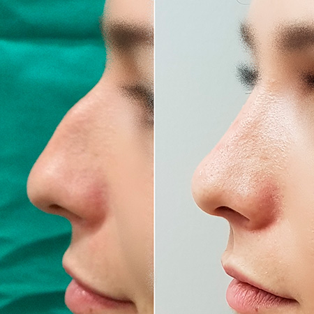 resultados esperados | Diferencia entre rinoplastia y rinomodelacion